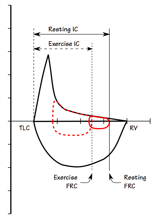 IC Exercise COPD