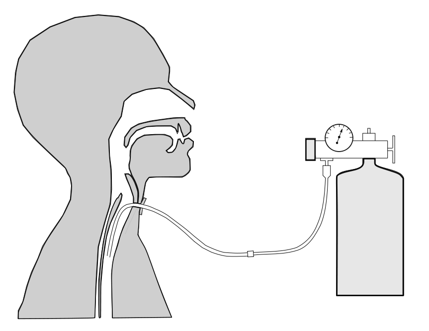 Transtracheal_Catheter