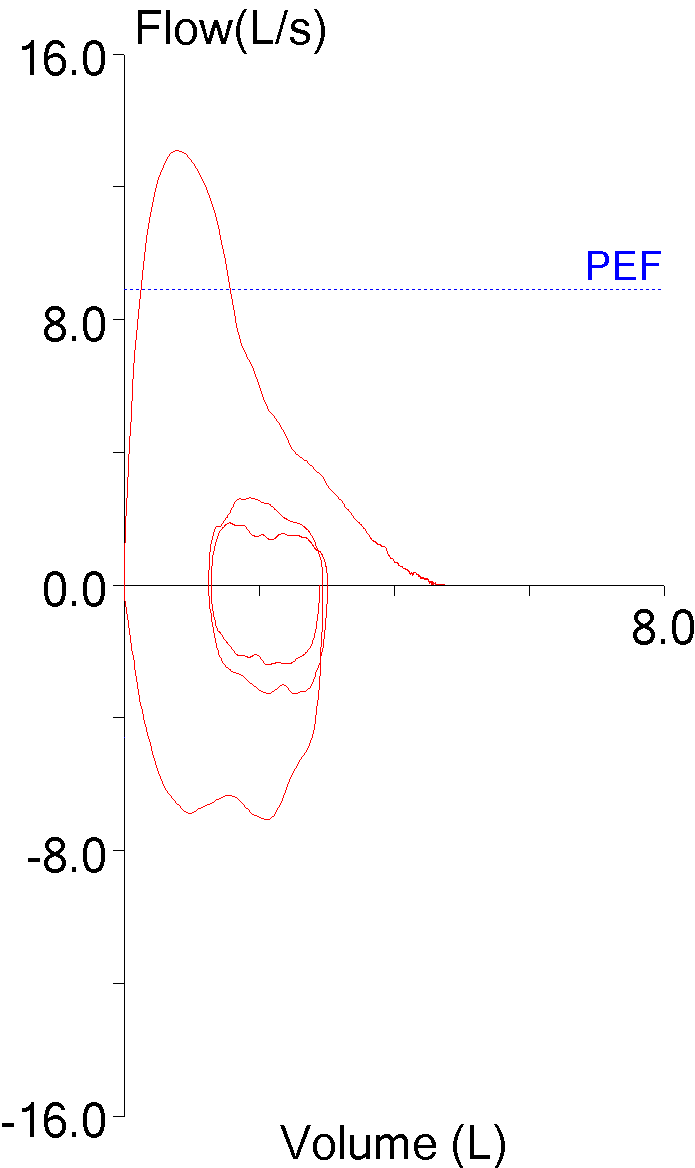 FVL_12_Elev_PEF_nl_FVC_FEV1