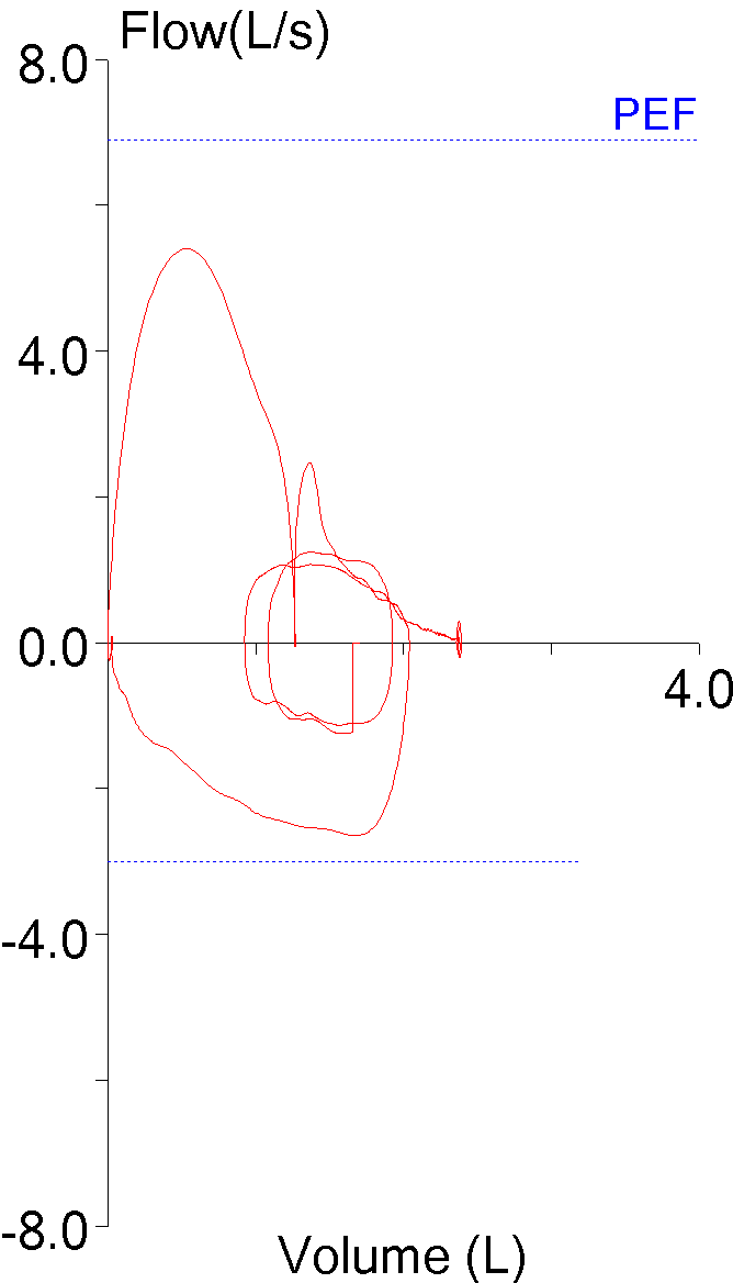 expiratory_pause_fev1_underestimated_fvl_2