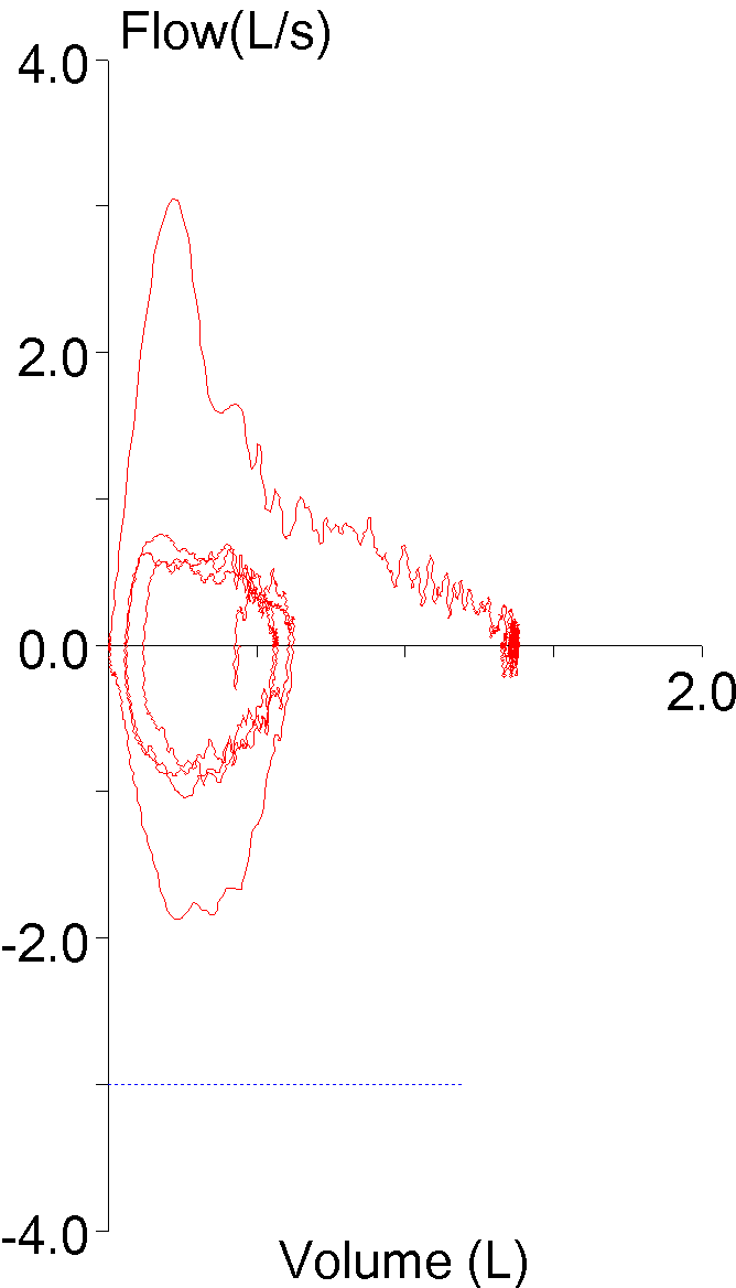 fvc_with_no_ic_redacted2