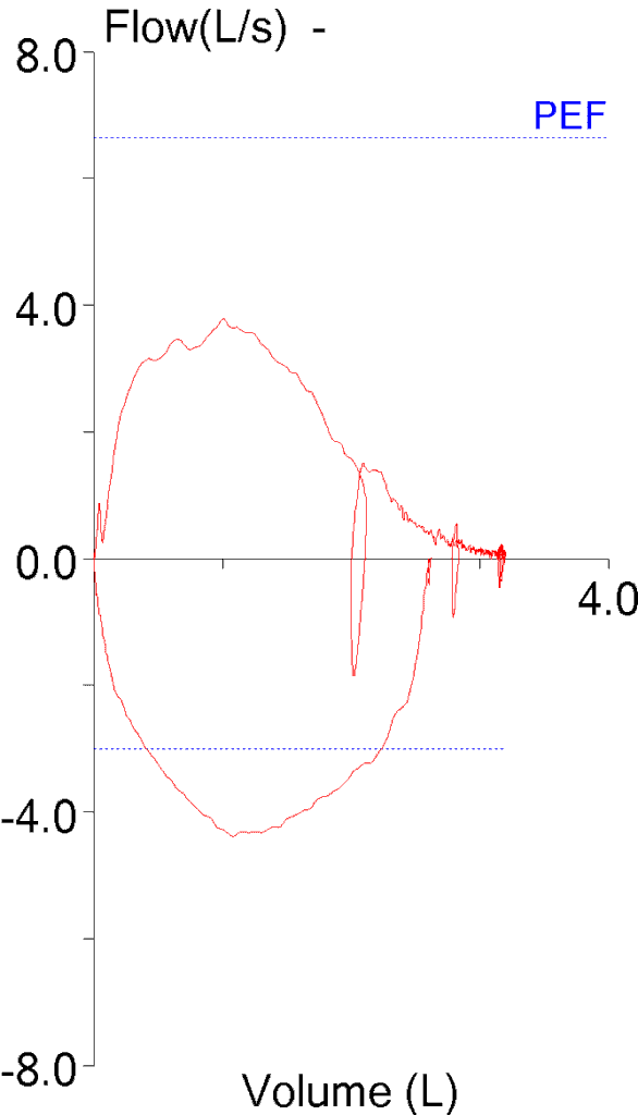 mid_expiratory_inspiration_fvc_underestimated_fvl