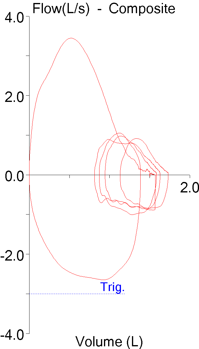 tidal_loop_drift_fvl